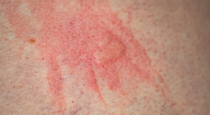 травить клопов